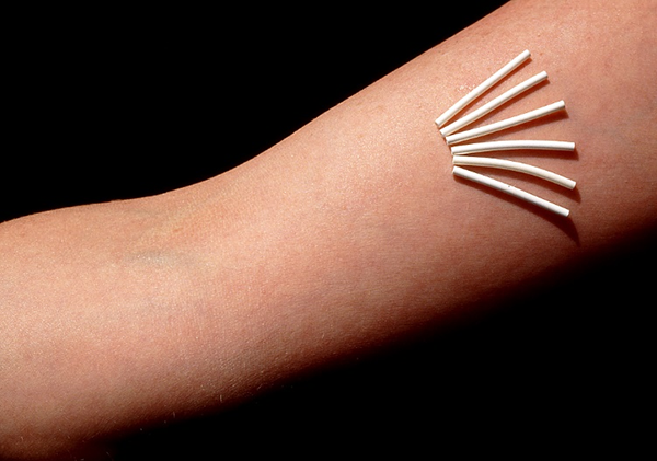 ⽪下埋植避孕法详细介绍